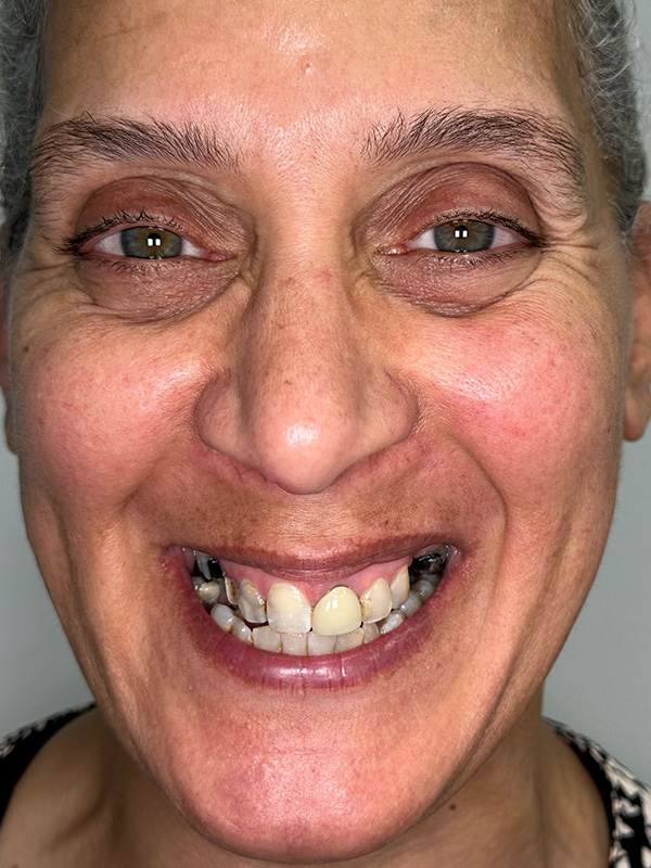 Patient 10 Face Before Photo