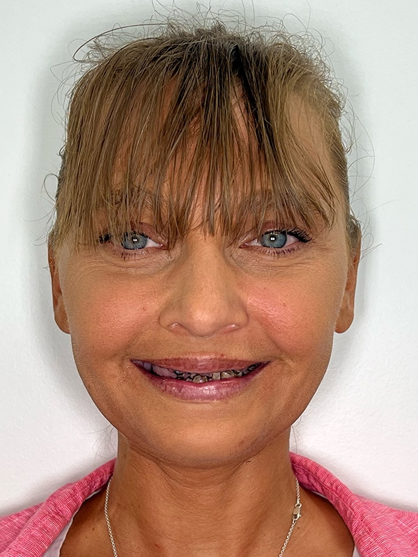 Patient 11 Face Before Photo