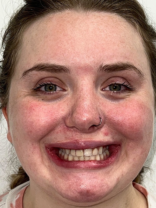 Patient 13 Face After Photo