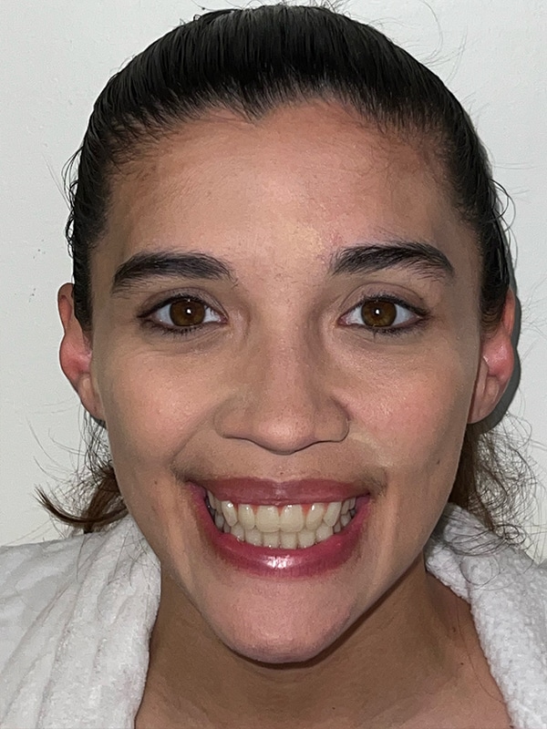 Patient 15 Face After Photo