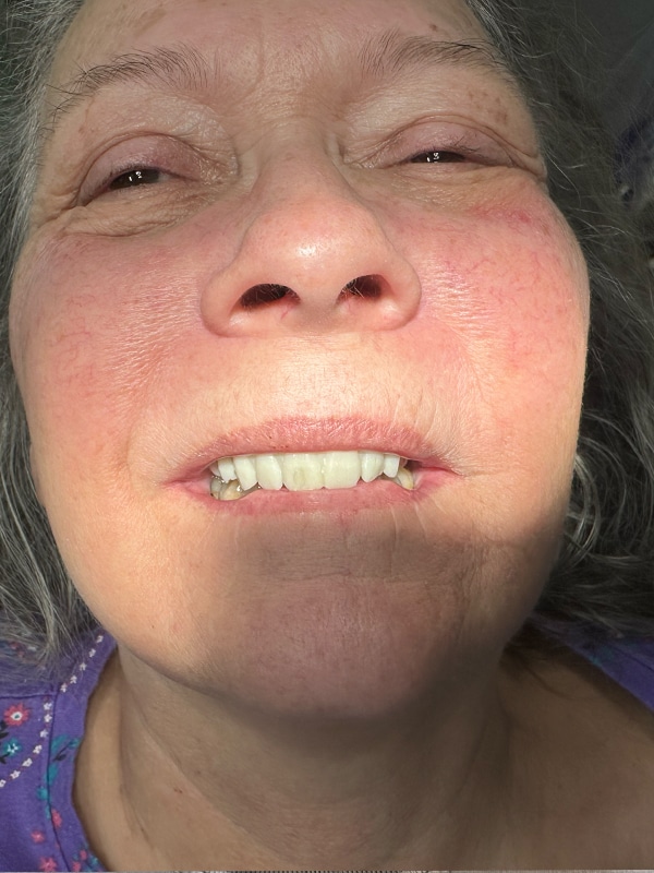 Patient 8 Face After Photo