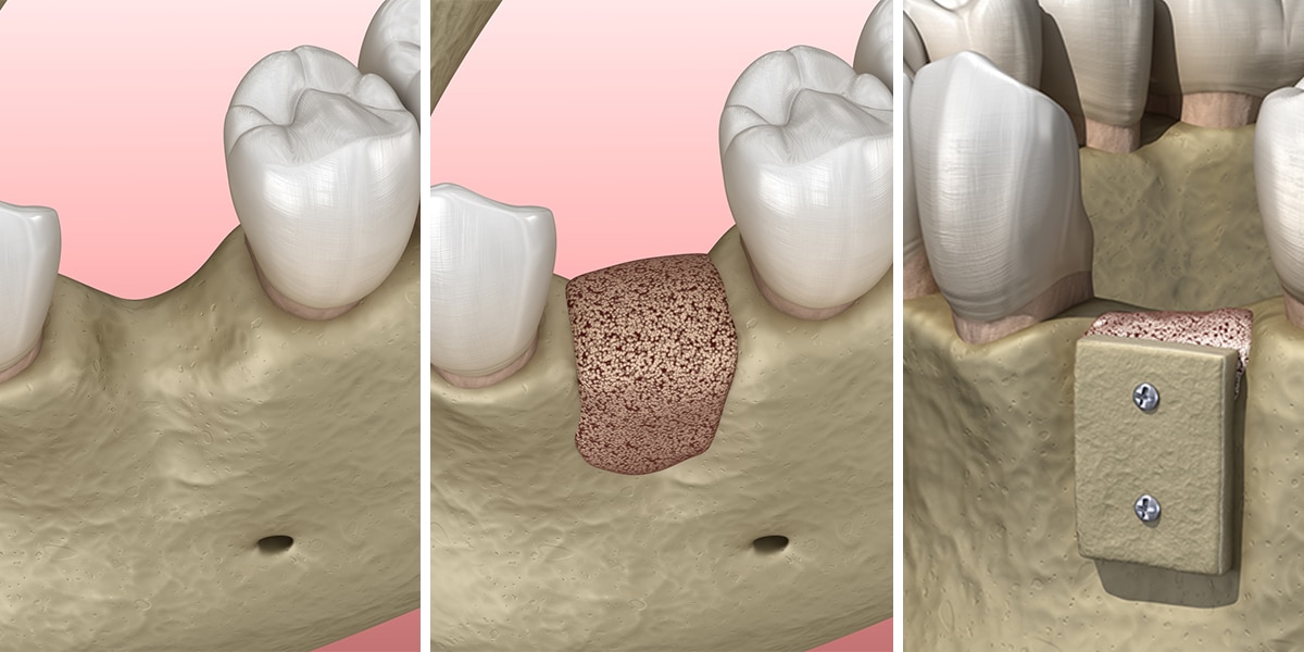 Bone Graft Photo