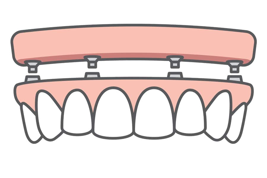 Full Arch Implant Wphoto